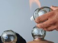 fire-cupping-1-1